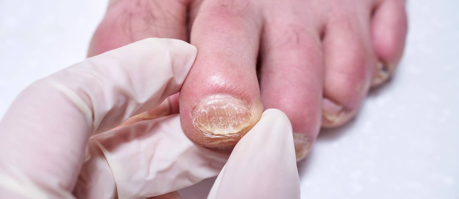 Micose nas unhas: sinais, perigos e opções de tratamento eficaz