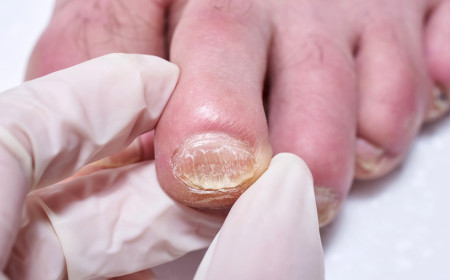 Micose nas unhas: sinais, perigos e opções de tratamento eficaz