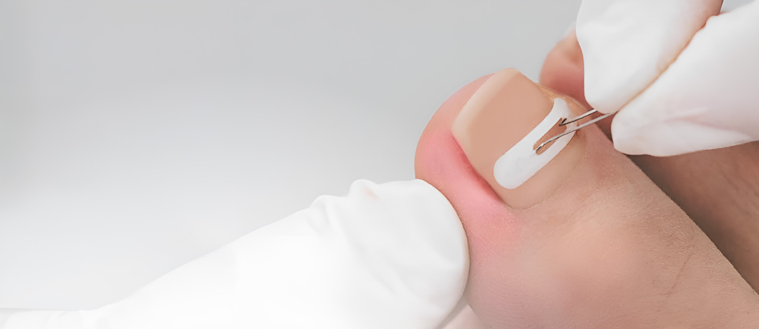 Confecção de Órtese para Correção das Unhas