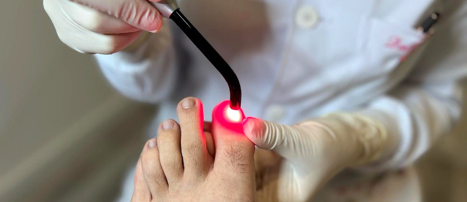 Tratamento de Micose nas Unhas