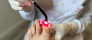Tratamento de Micose nas Unhas