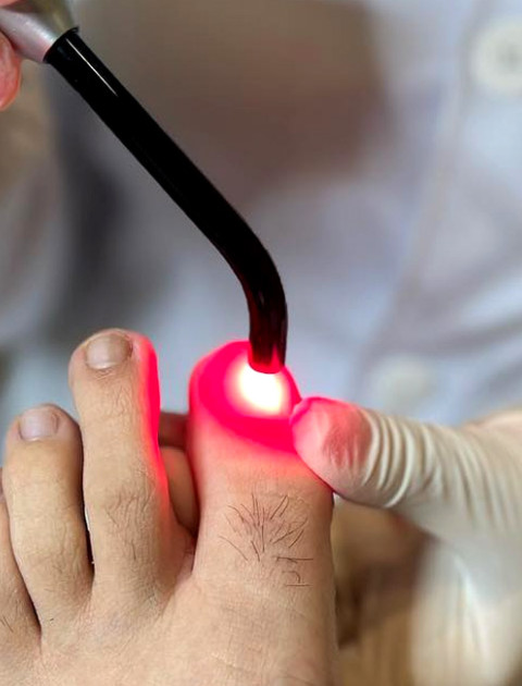 Tratamento de Micose nas Unhas